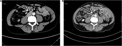 Sex Cord-Stromal Tumors of Testis: A Clinicopathologic and Follow-Up Study of 15 Cases in a High-Volume Institute of China